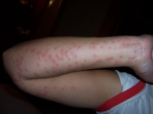 tempe bed bugs